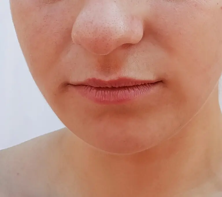 Restylane_injection_before