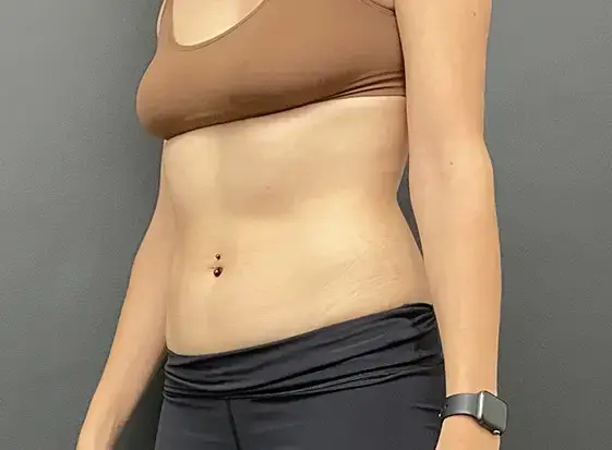 BA- emsculpt (1)