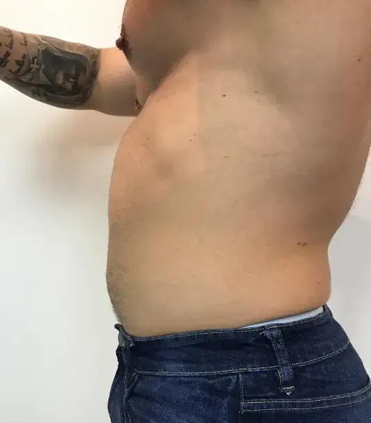 emsculpt (1)