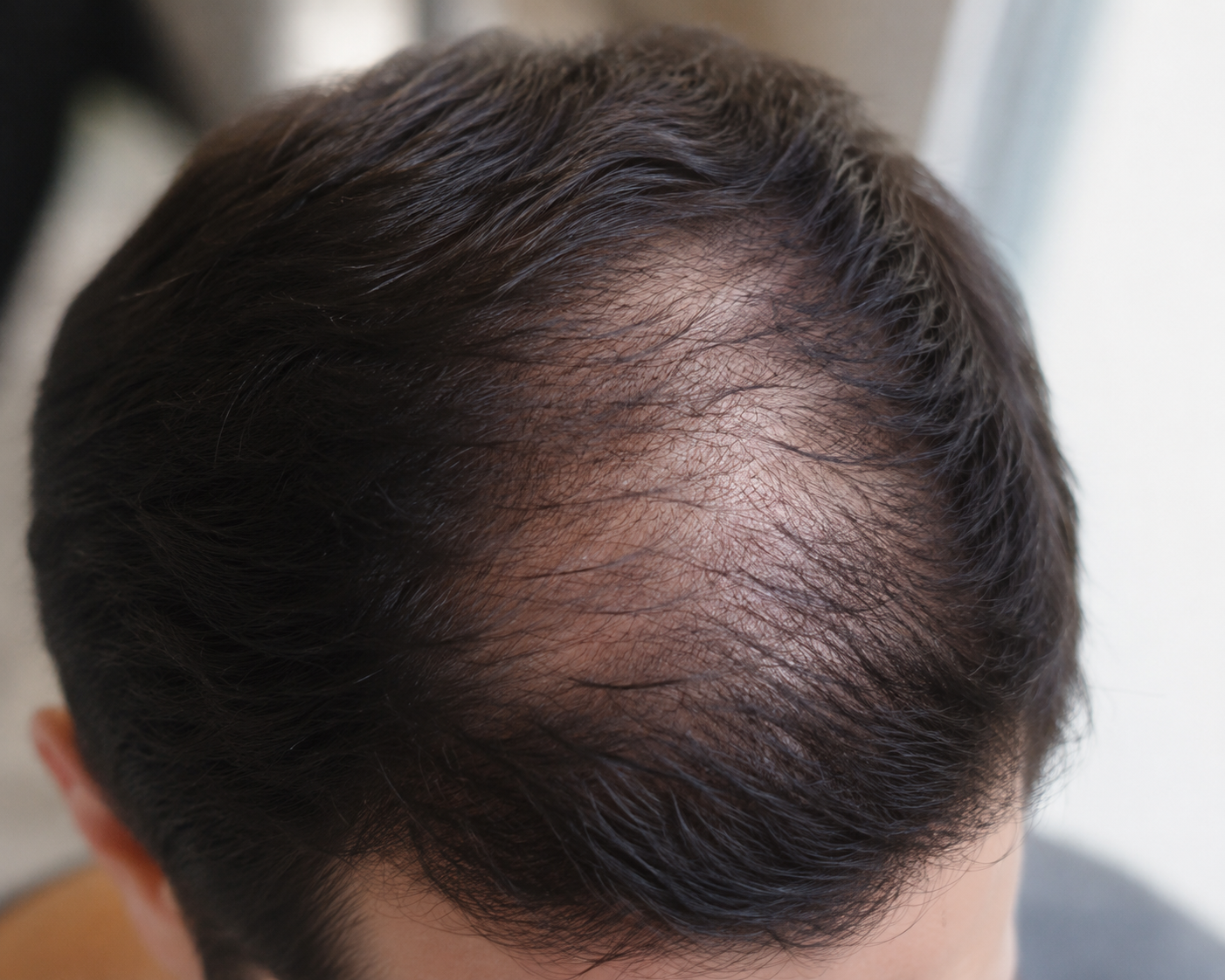 Cheveux clairsemés et perte de densité capillaire au niveau du cuir chevelu