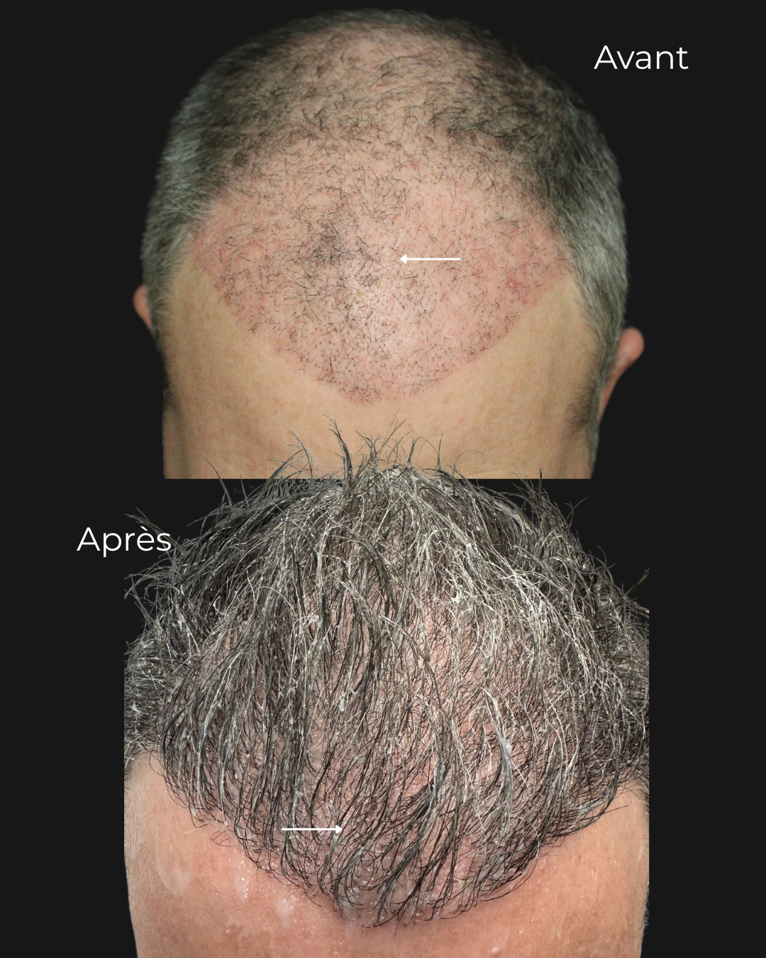 Avant/après d’un traitement capillaire visant à améliorer la densité et la repousse des cheveux