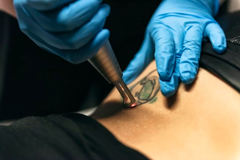 DÉTATOUAGE