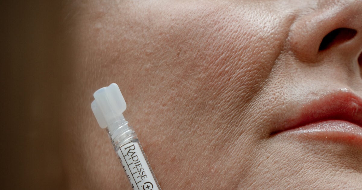Je fais déjà du botox ou des fillers