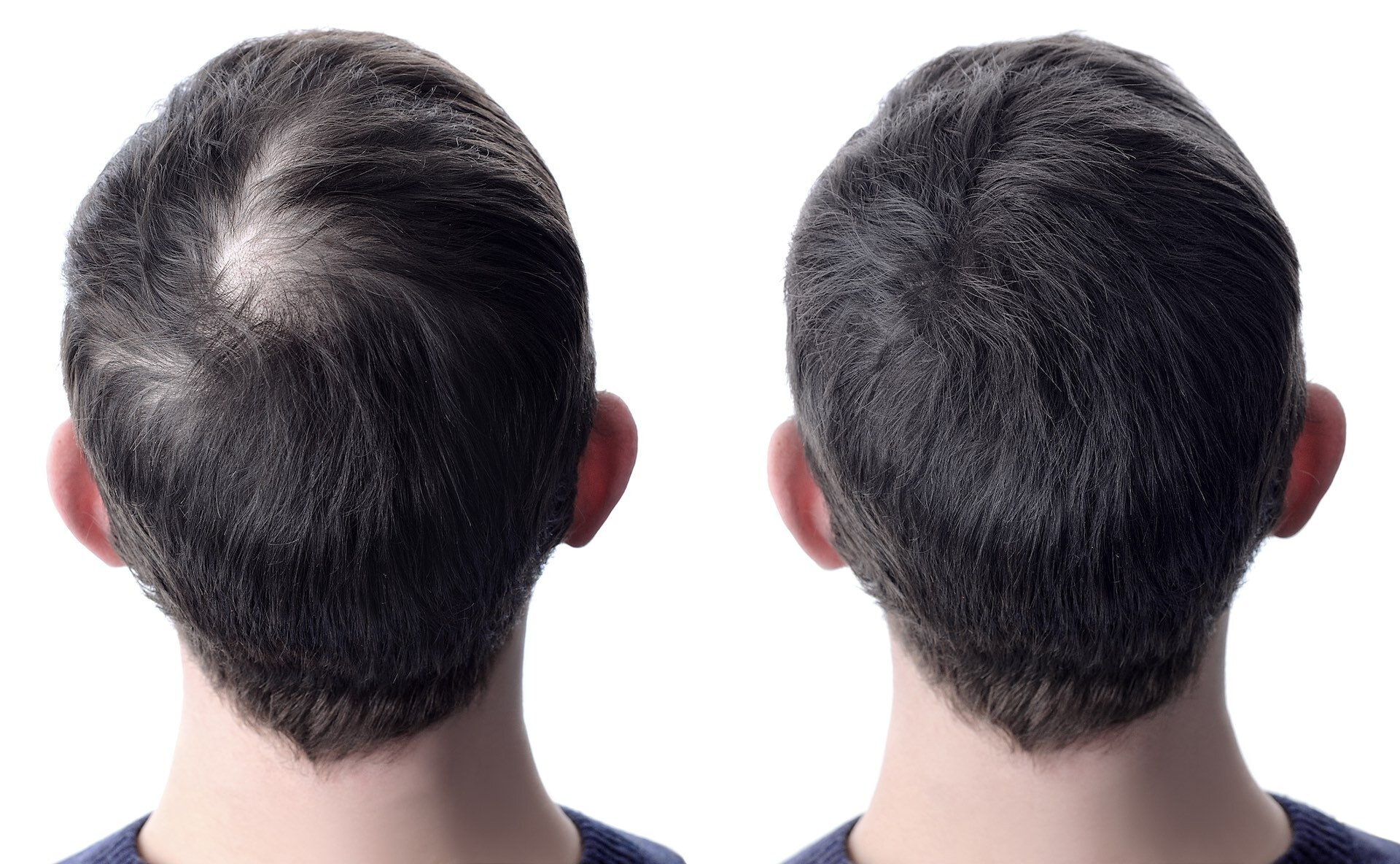 PRP - Traitement chute de cheveux chez MRockland, Montréal